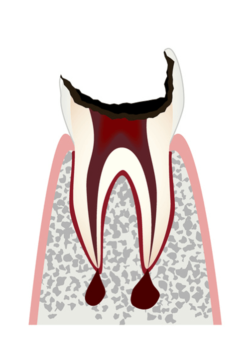 歯の頭（歯冠）が失われた歯＝残根